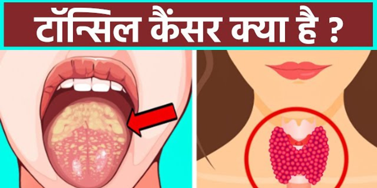 Tonsil Cancer: तंबाकू खाते हैं सावधान हो जाओ, हो जाएगा गले का कैंसर, जान बचानी हो जाएगी मुश्किल